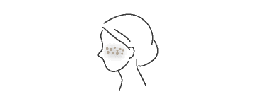 肝斑（かんぱん）