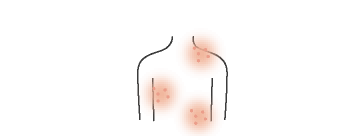 じんま疹