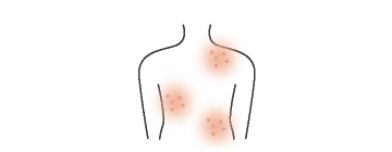 じんましん